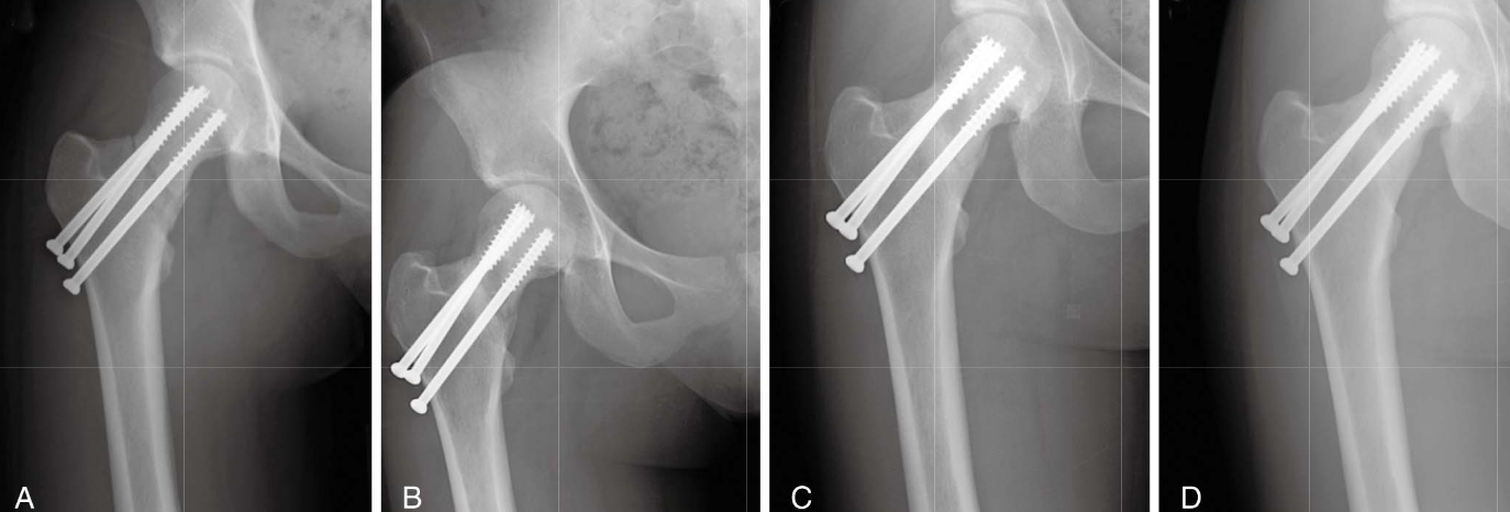 Реабилитация после перелома бедренной кости (без операции)