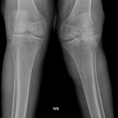 Протокол реабилитации после травмы мениска коленного сустава (без операции)