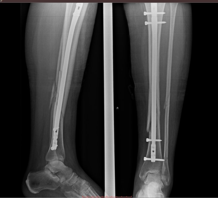 Интрамедуллярный стержень в бедренной кости (рентген)
