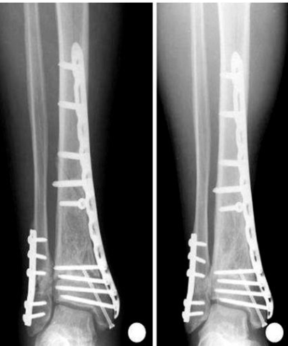 Фиксация бедренной кости винтами и пластиной (Рентген)