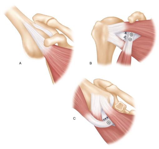 Реабилитация (лечение) после открытой передней стабилизации плеча с костной пластикой (Операция Латардже)