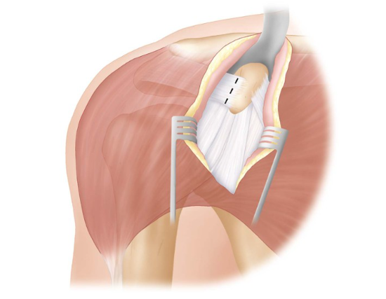 Реабилитация (лечение) после открытой передней стабилизации плеча с костной пластикой (Операция Латардже)