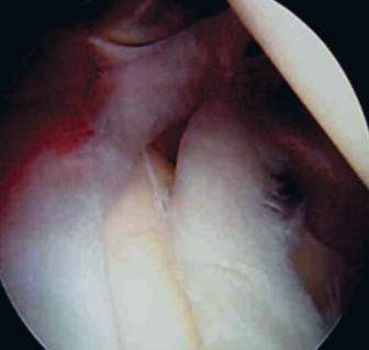 Реабилитация при повреждения суставной губы по типу SLAP (без операции)