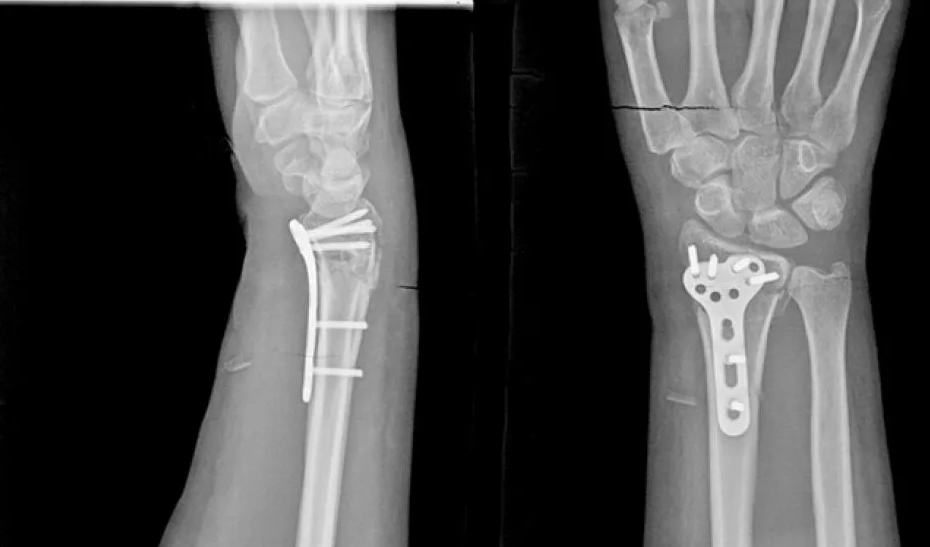 Реабилитация после перелома лучевой кости (без операции и после)