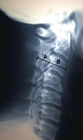 Рентген: Радикулопатия шейного отдела