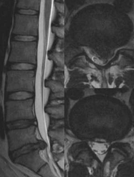 Люмбаго – неспецифическая боль в спине и корешковый синдром