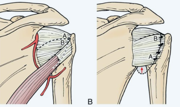 Протокол реабилитации при нестабильности плеча (разнонаправленная)